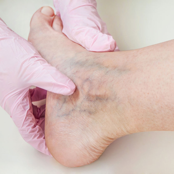 Vein disease